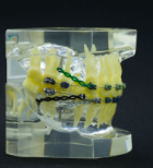 השתלות שיניים והעמסה מיידית-תמונה